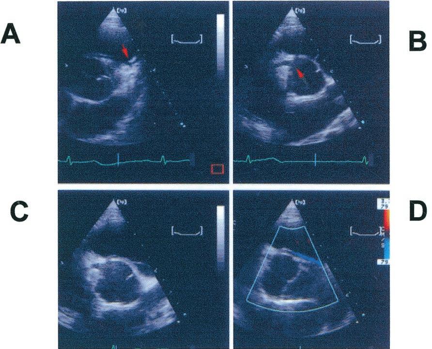JACC Vol. 37, No. 2, 2001 February 2001:593 7 Davis et al. Coronary Artery Anomalies in a Pediatric Population 595 Figure 3. Arrow in A shows the origin of the RCA from the left sinus of Valsalva.