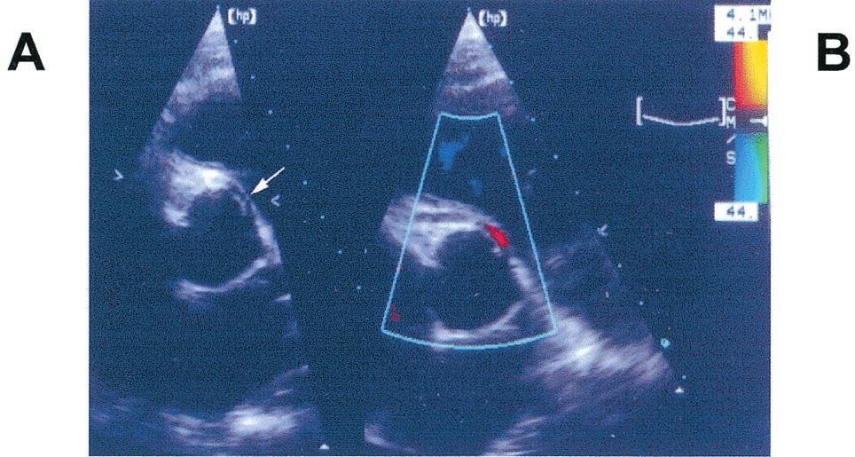The principal goal of this study was to determine the prevalence rate of anomalous origin of a coronary artery (AOCA) in an otherwise normal pediatric population.