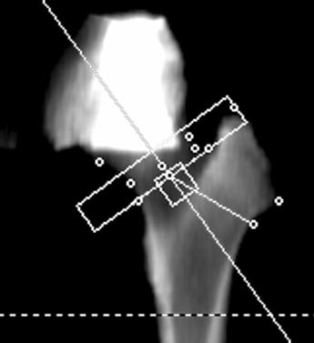 QCT of the Spine and Hip A B C Fig. 2 69-year-old woman with colon cancer. Use of CT data sets for evaluation of bone mineral density (BMD) in hip.