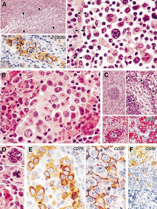 B-cell Anaplastic Large-cell Lymphoma 587 Fig 1. Histological features of cases of `anaplastic large-cell lymphoma' expressing B-cell markers.