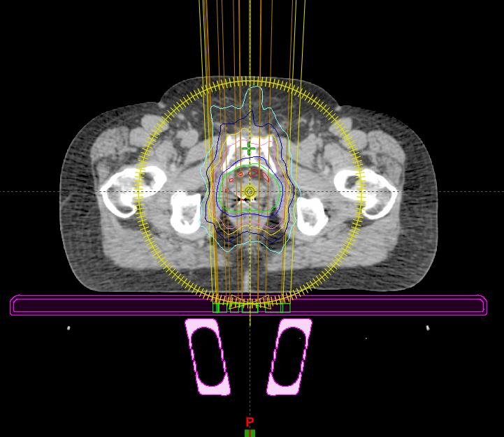 1. Imaging insert and rails in the out position (referred to as the rails out plan), representing a scenario in which the rails are not moved during treatment 2.