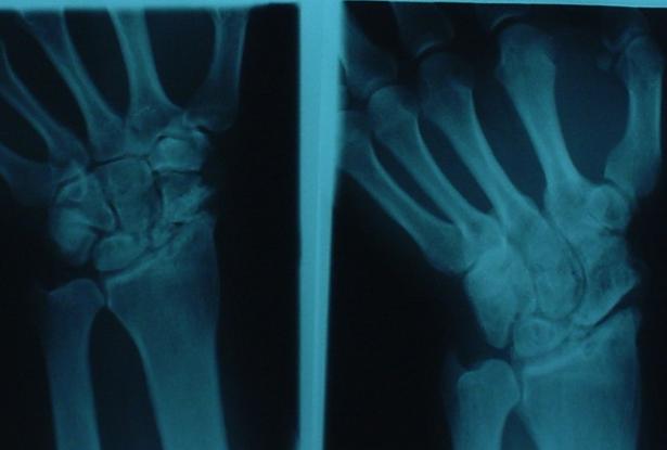 SNAC I : Styloid-scaphoid arthritis II : Styloscaphoid + Scaphocapitate arthritis III: Above + Lunocapitate arthritis IV Whole wrist arthritis SLAC I : Stylo-scaphoid arthritis II: Whole scaphoid and