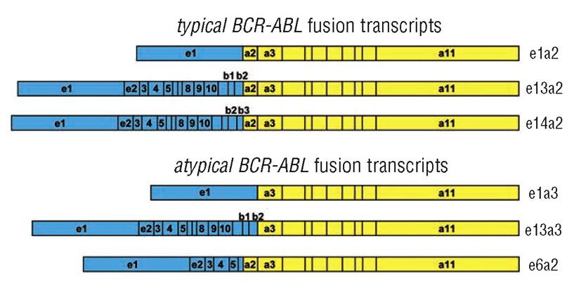 Case 4 Exon 13 BCR Exon 3 ABL1 459 fusion reads BCR-ABL fusion transcripts