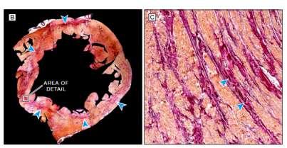Pathology in NIDCM Diffuse presence of: reactive (interstitial)