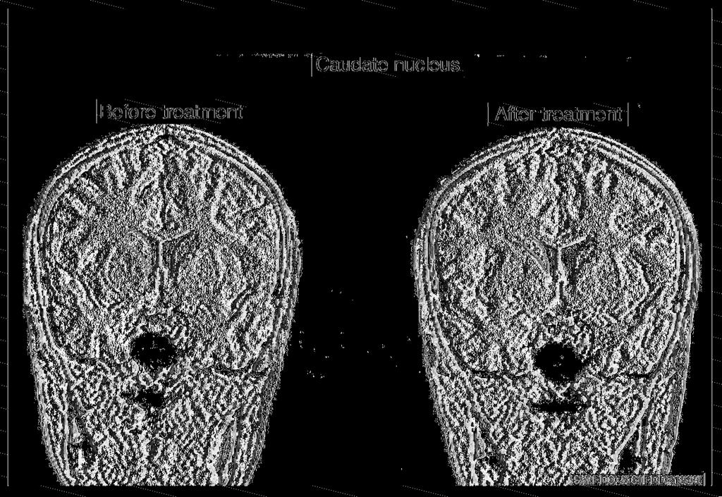 Figure 3 Serial T1-weighted brain MRIs of a 14-year-old male patient with severe worsening of OCD symptoms after an infection with GABHS.