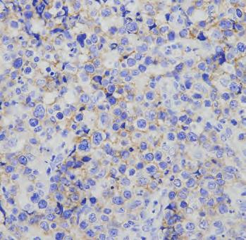 We consider that this case can not confirm NK/Tcell lymphoma associated with CAEBV.