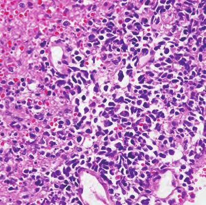 A unique case of NK/T cell lymphoma Fig. 3. Histological findings at relapse in 2006. Lymphoid cells have pleomorphic feature with necrosis, similar to the initial tumor. H&E stain, 400.