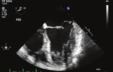 Left untreated, chronic severe MR leads to left ventricular remodeling, myocardial dysfunction, heart failure, left atrial dilatation, atrial fibrillation and pulmonary hypertension.