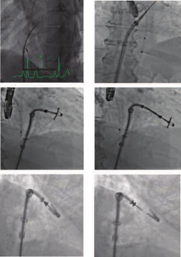 Page 6 of 11 Figure 6. Fluoroscopic steps of the procedure. (A) Atrial septal puncture. (B) Guide catheter advanced into left atrium.