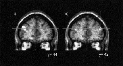 The left hemisphere is shown on the left side of the figure. i) Backward digit span minus control.