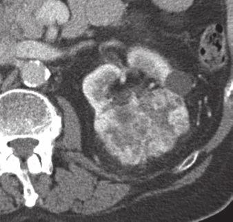 CT Differentiation of Adrenal Masses in Patients With RCC ly enhancing parts, and the mean attenuation value was recorded (Fig. 3).
