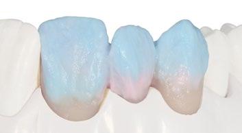 02 Build up the upper part of the crown with Celtra Ceram Dentin A2 and create delicate mamelon structures.