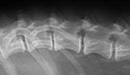 4. Radiographic signs: - calcified disc is not pathognomistic - narrowed