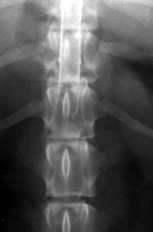 instability of cervical vertebrae (C4-7), malarticulation, narrowed