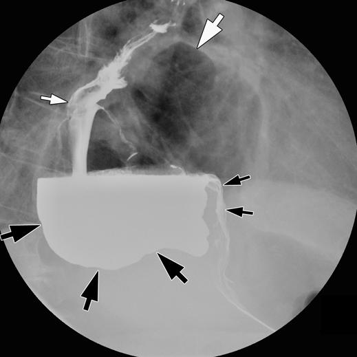 Radiography of Hiatal Hernia fect of the accumulation of ingested food and liquids in the dependent portion of the flopped fundus, impeding emptying of the hernia.