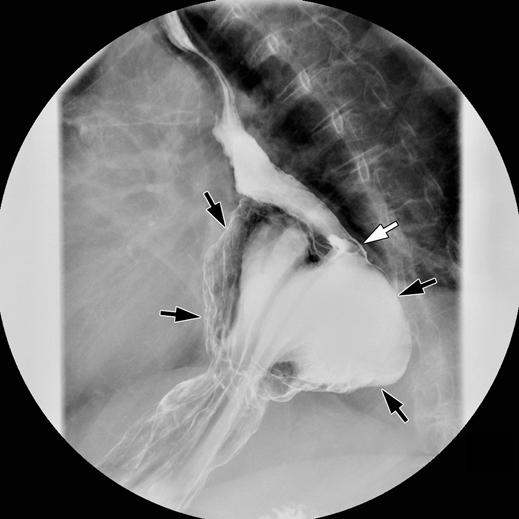 patients with mechanical symptoms but no floppy fundus had delayed emptying of the hernia (p < 0.0001).