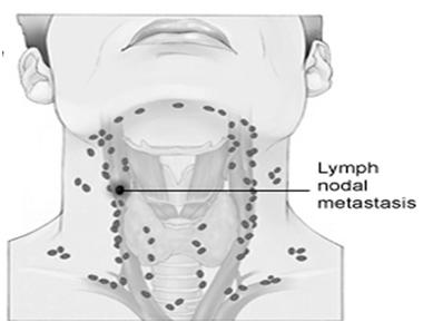 MUCOSAL MELANOMA OF THE HEAD AND NECK Occur in mucosal sites of the head and neck Two thirds occur in nasal cavity and paranasal sinuses One quarter occur in oral cavity Remainder occur in