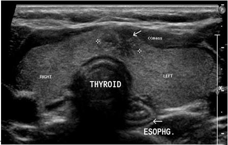 THYROID NODULES Hot nodule Absorbs iodine on thyroid scan Cold Nodule Does not absorb iodine on thyroid scan TREATMENT FOR PAPILLARY AND FOLLICULAR CARCINOMA Surgery Ipsilateral lobectomy plus