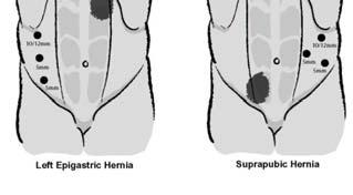 from previous incisions Adhesiolysis performed and the hernia is