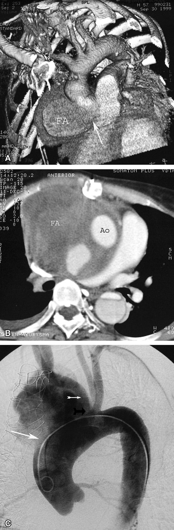 Ann Thorac Surg BACHET ET AL 2007;83:1610 4 GIANT FA OF THE THORACIC AORTA 1611 tive cerebral cold (10 C to 12 C) perfusion is initiated, while the circulation is discontinued in the main circuit.