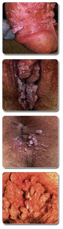 Genital wart epidemiology HPV causes all ano-genital warts Globally 90% caused by HPV 6 & 11 Genital warts are the most common