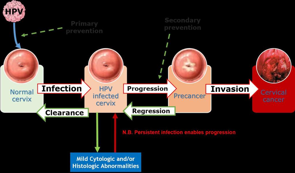 Natural history of cervical carcinogenesis Diagram