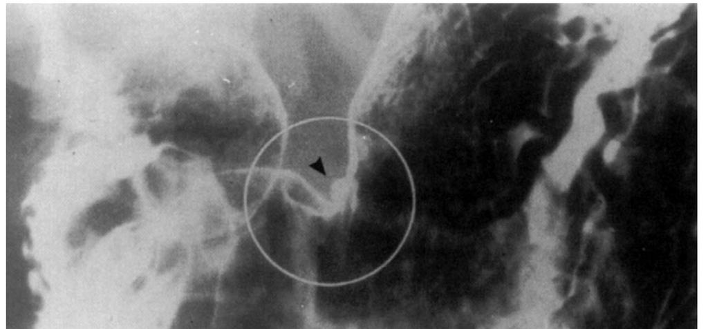Figure 5 X- radiograph of peptic ulceration. The arrow indicates an irregularity in outline where barium contrast medium has filled an ulcer crater on the lesser curve of the stomach 7.