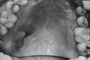 M. UMEDA et al. Fig. 1. Intraoral views show slight swelling of the palate. The ulceration was caused by the biopsy procedure performed at the former hospital. 46 Fig. 2.