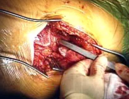 Muscle cutting approaches used Bone sparing...femoral neck preservation - what about the acetabulum?