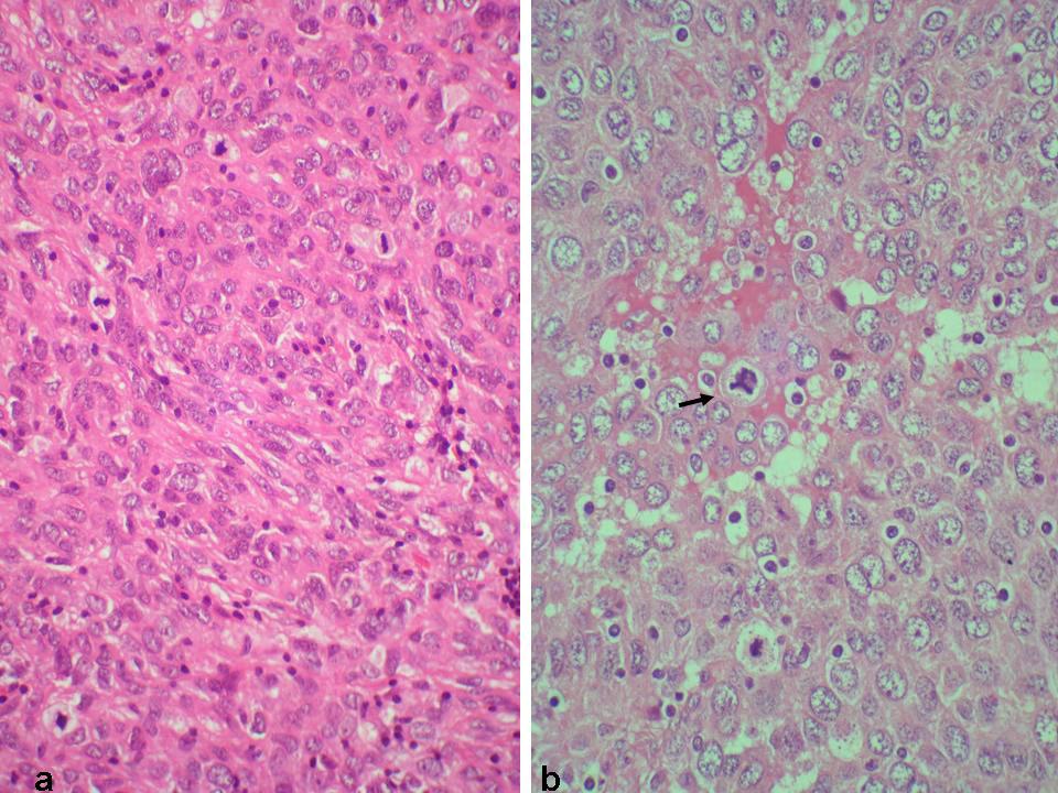 Malaysian J Pathol December 2008 FIG. 1a: Inguinal lymph node showing loss of architecture and replacement with diffuse sheets of pale staining cells (H & E; X 40).