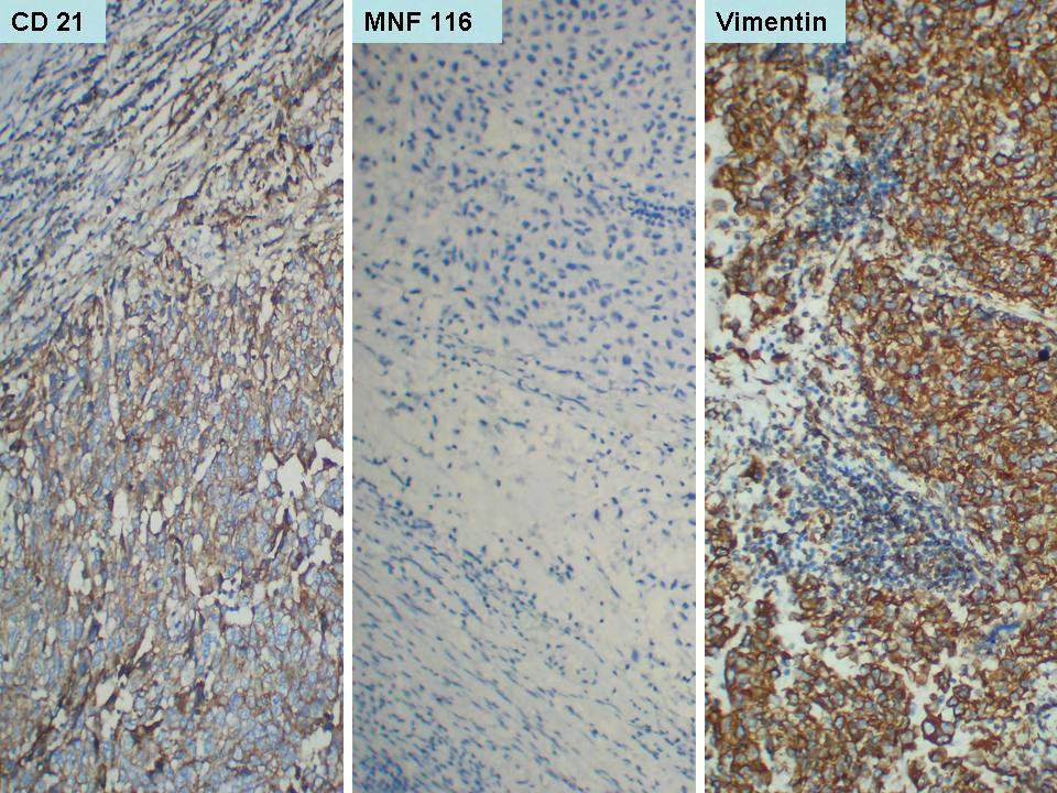 FOLLICULAR DENDRITIC CELL SARCOMA FIG. 3. Tumour cells are positive for CD21 and vimentin, while epithelial marker, MNF116 is negative (Immunoperoxidase stain X 200).