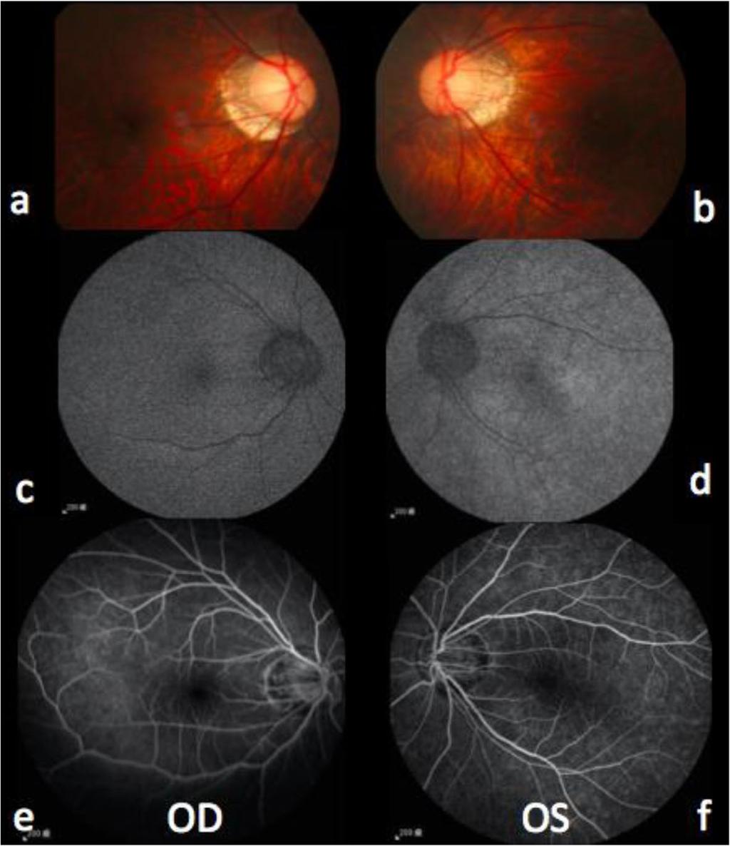 Kuo et al. BMC Ophthalmology (2017) 17:236 Page 3 of 6 Fig. 2 Binocular images of color fundoscopy, fundus autofluorescence, and fluorescein angiography on the next day after onset of symptoms.