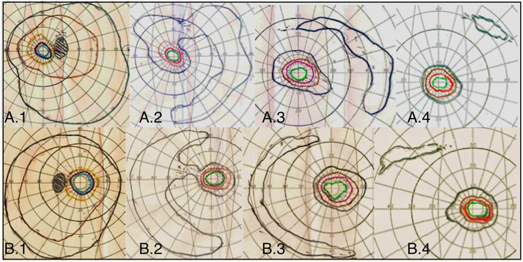 Page 5 of 6 Fig. 4 Visual field. Progression of visual field loss at the first examination (A.1, B.1), after 6 (A.2, B.2), 8 (A.3, A.3) and 22 (A.4, B.