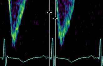 Pre-ejection time from the Q wave of the ECG (a) to the onset of the Doppler velocity