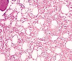 Amyloid deposits were identified readily by using routine stains, as well as special tissue stains. With PAS, the deposits had a distinct smudgy appearance Image 4A.