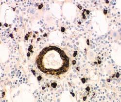 immunofluorescent staining of bone marrow aspirate slides with immunohistochemical analysis of bone marrow core biopsy specimens in 26 patients with an occult plasma cell dyscrasia (plasma cells