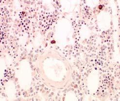 biopsy. 6 In a study involving 52 patients with AL amyloidosis, immunofluorescent staining of bone marrow aspirate slides alone identified plasma cell clonality in 44 patients (85%).