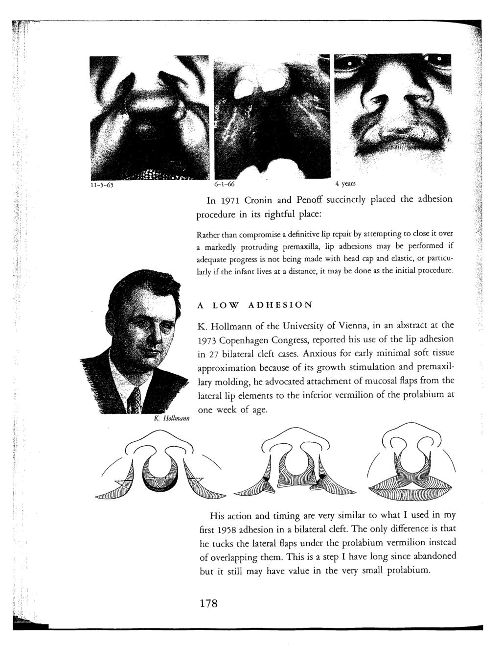 1971 CRONIN AND PENOFF SU PLACED THE ADHESION RIGHTFUL PLACE RATHER THAN COMPROMISE DEFINITIVE LIP REPAIR BY ATTEMPTING TO CLOSE IT OVER MARKEDLY PROTRUDING PREMAXILLA LIP ADHESIONS MAY BE PERFORMED