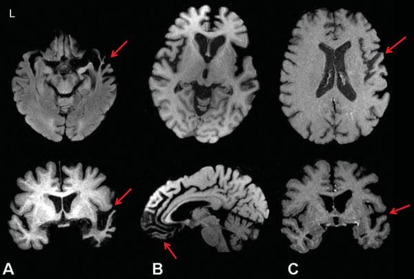 396 Neuroimaging Biomarkers of Neurodegenerative Diseases and Dementia Risacher, Saykin presence of more white matter lesions is also significantly associated with impaired cognition, particularly in