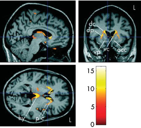 402 Neuroimaging Biomarkers of Neurodegenerative Diseases and Dementia Risacher, Saykin Fig. 6 Atrophic changes in early Huntington s disease (HD) relative to healthy adults.