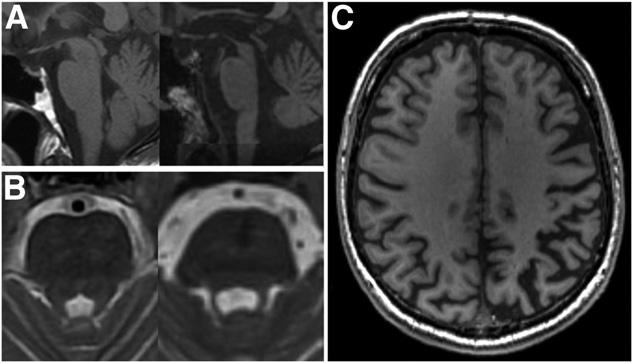 FIGURE 4. MR imaging appearance of progressive supranuclear palsy and corticobasal degeneration subtypes of FTLD.