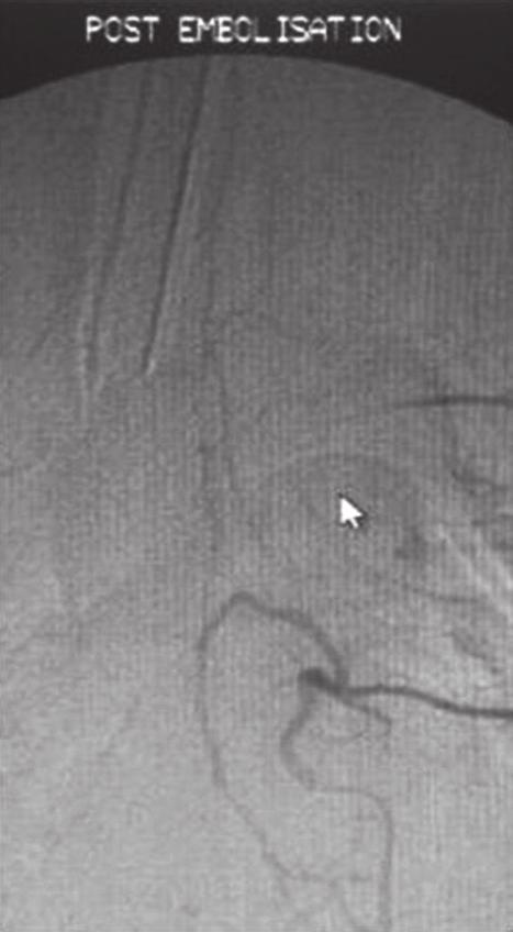Angiography was performed preoperatively in patients in whom the diagnosis was doubtful or whose MRIs showed multiple flow voids on T2-weighted images.
