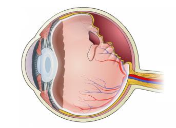 PVD is more likely to occur if a person has had cataract surgery, trauma to the eye or inflammation inside the eye.