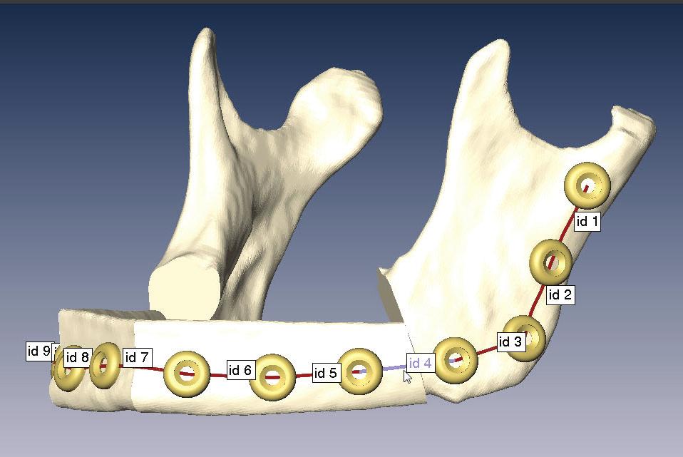 Additionally, the designer can pass the control to the surgeon so that together they can define screw hole positions to avoid interference with nerves, tooth roots, osteotomies and