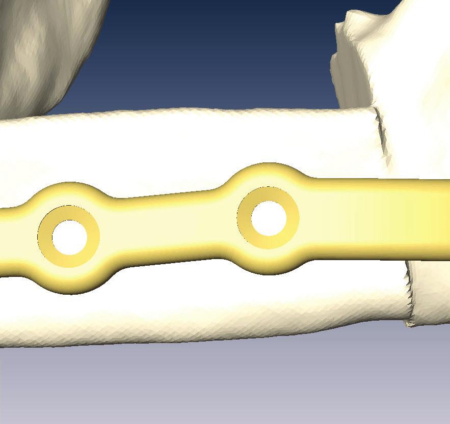 Specific screw hole positions are defined individually to avoid screw interference with nerves, tooth roots, osteotomies and existing or future implants.