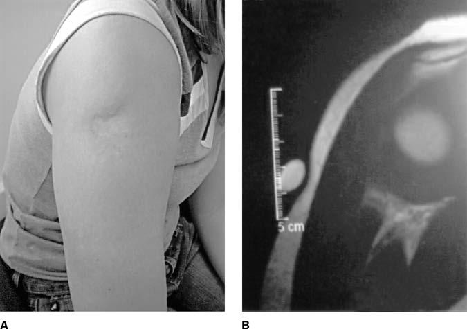 days. 49 Skin or fat atrophy after injection (Fig. 2) may be more common with less soluble agents, such as the triamcinolone compounds.