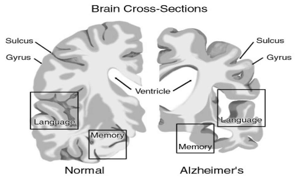Overview of Alzheimer s Disease Visual Representation of Alzheimer s Disease These frontal cross-sections of the brain provide a view of a normal brain and a brain of someone who has Alzheimer s