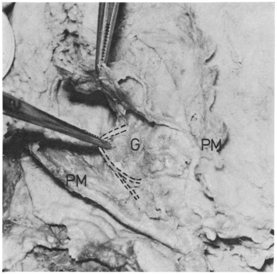 SURGICAL ANATOMY OF THE CERVICAL NERVE 175 F IG. 3. A close-up photograph to show the bifurcation of the cervical nerve (dotted lines) near the gonion (G). The platysma muscle (PM) has been reflected.