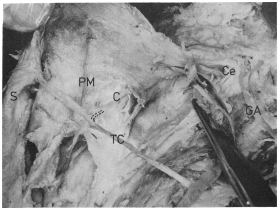 176 BRITISH JOURNAL OF ORAL SURGERY FIG. 4. A dissection showing anastomotic branches of the great auricular nerve (GA) entering the parotid glznd posterior to the emerging cervical nerve (Ce).