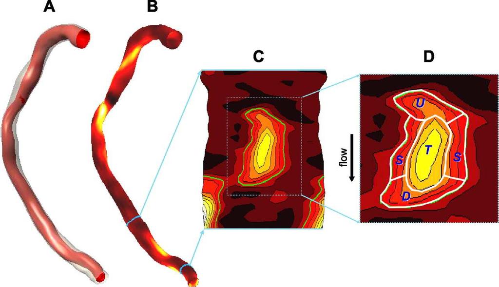 The results of the 3-dimensional reconstruction of a right coronary artery are given in A.
